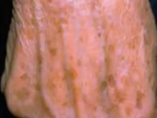 ویدئو :  تماسک سفیده تخم مرغ برای خال های قهوه ای روی پوست