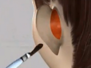 ویدئو:   عمل جراحی زیبایی گوش به چه صورت است؟