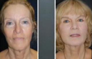 ویدئو : ورزش صورت برای رفع خط لبخند