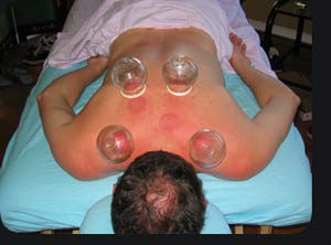 ویدئو :  آموزش بادکش درمانی یکی از فنون موثر طب سنتی