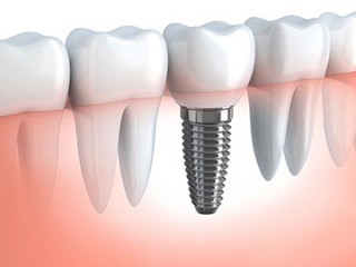 ویدئو : ایمپلنت کردن دندانها