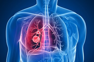 ویدئو :   زمان تشخیص سرطان ریه