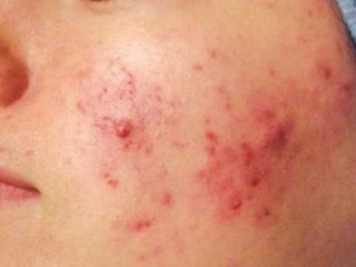اگر جوش زیاد می زنید، این خوراکی ها را نخورید