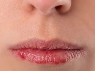 معرفی علائم و دلایل ایجاد اگزمای لب