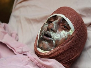 قطع عضو و کوری از عوارض حوادث چهارشنبه آخر سال