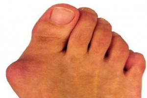 علل ایجاد انحراف انگشت شست پا +درمان
