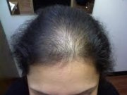 ۶ دلیل عمده ریزش مو در خانمها + روشهای درمانی