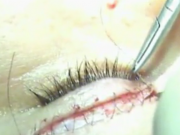 ویدئو : جراحی پلکهای شرقی ایرانی (چشم بادامی) (مطلب)