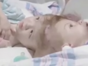 ویدئو : جراحی سنگین جداسازی سر دو نوزاد در آمریکا (مطلب)