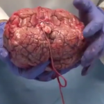 ویدئو :  ویدیویی حیرت انگیز از کالبد شکافی مغز انسان (مطلب)