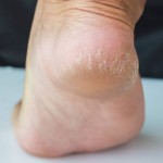راهکارهای موثر برای درمان ترک های پاشنه پا (مطلب)