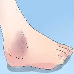 راهکارهایی برای رفع تیرگی قوزک پا (مطلب)