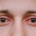 این علایم در چشم ها نشانه چیست؟ (مطلب)