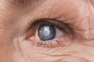 آب سیاه چشم: ۷ درمان خانگی گلوکوم + علائم آب سیاه چشم (مطلب)