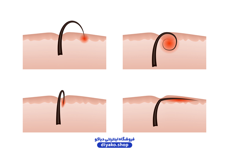 دلایل ایجاد موی زیرپوستی چیست؟ + روش درمان آن