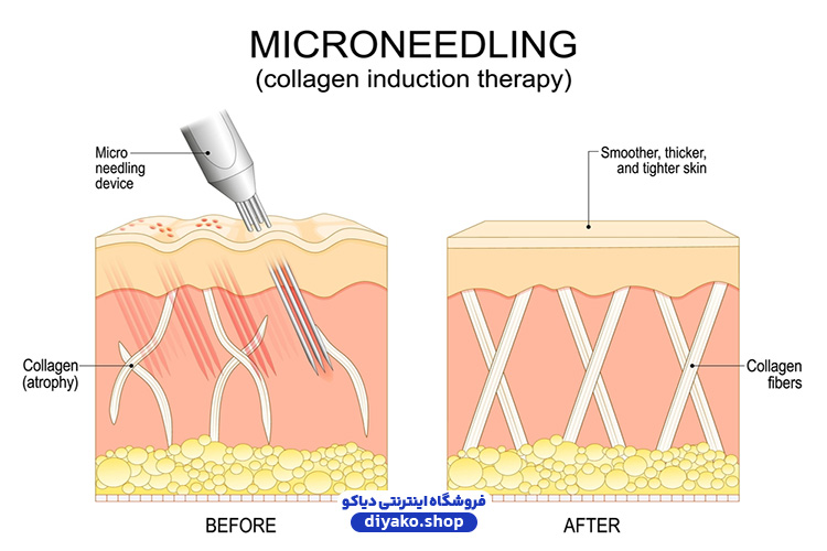 میکرونیدلینگ پوست چیست