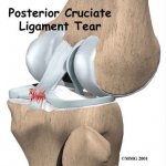 درمان آسیب رباط صلیبی زانو با دستگاه فیزیوتراپی خانگی فارادیک برجیس
