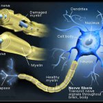کنترل و درمان بیماری MS (مالتیپل اسکلروزیس) با دستگاه فیزیوتراپی خانگی فارادیک بریجیس