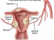 راه حل های درمانی خانگی برای فیبروم رحمی