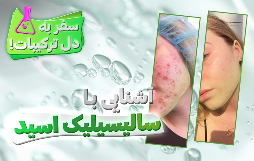 سالیسیلیک اسید، فرشته نجات پوست چرب!