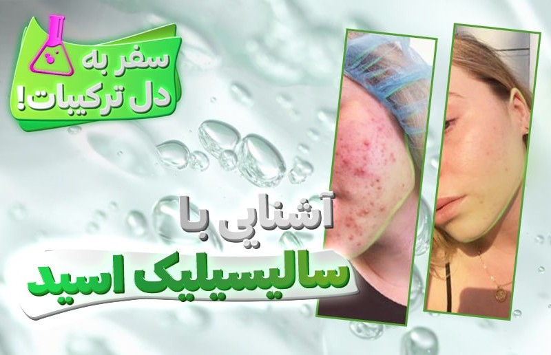 سالیسیلیک اسید، فرشته نجات پوست چرب!