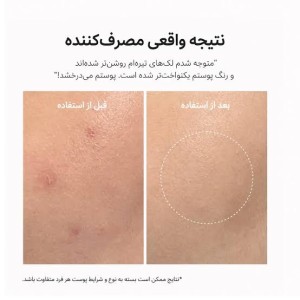 بوستر شات ترانگزامیک اسید آرنسیا arencia