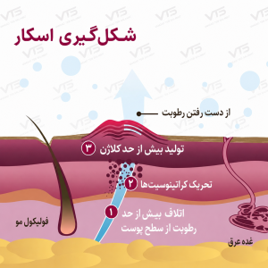 مراحل شکل‌گیری اسکار و تولید بیش از حد کلاژن