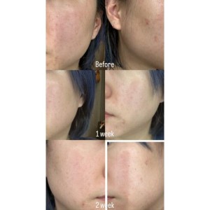 آمپول کنترل کننده منافذ سنتلا ماداگاسکار 100 میل - Madagascar Centella Poreminizing Fresh SKIN1004