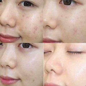 آمپول کنترل کننده منافذ سنتلا ماداگاسکار 100 میل - Madagascar Centella Poreminizing Fresh SKIN1004