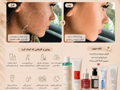 روتین کامل درمان جوش زیرپوستی و جای جوش؛ راهنمای جامع برای پوستی صاف، شفاف و بدون التهاب