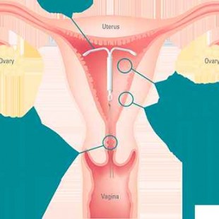 آی یو دی میرنا IUD MIRENA