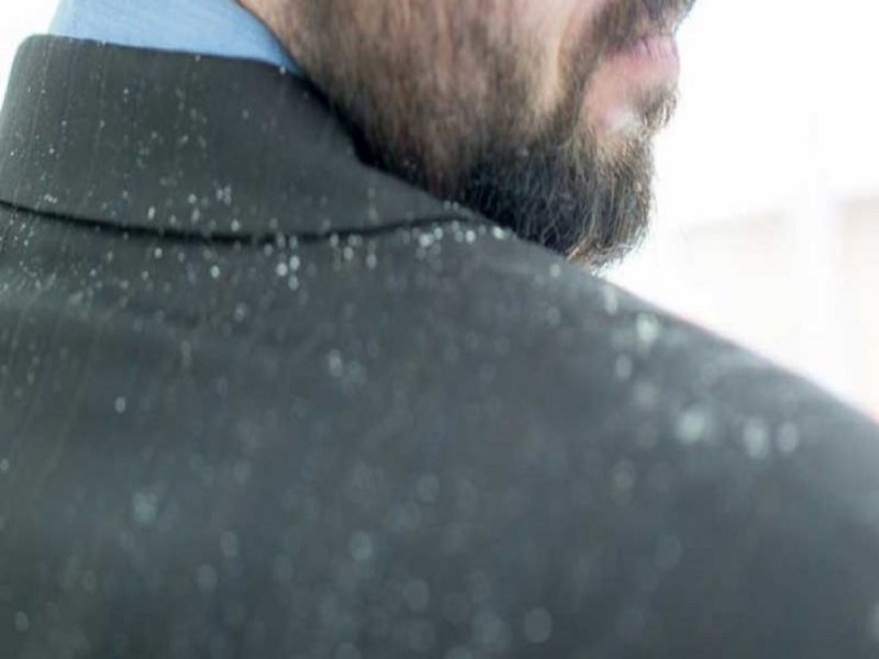 چگونه شوره‌ سر را نابود کنیم؟