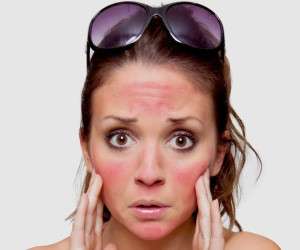 آفتاب سوختگی و بهترین روش ها برای درمان آن