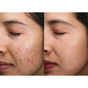 سرم نیاسینامید 10% و زینک 1% نو آکنه 30ml