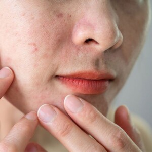 سرم آلفا و بتا هیدروکسی اسید ژنوبایوتیک 30ml