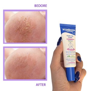 کرم برطرف کننده پوسته های چرب سر نوزاد هیدرودرم