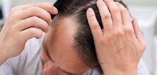 روش های درمان خشکی مو با ماسک خانگی