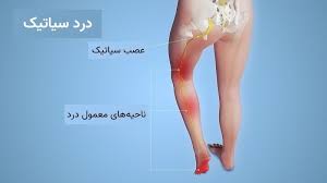 بررسی علائم و علت درد سیاتیک