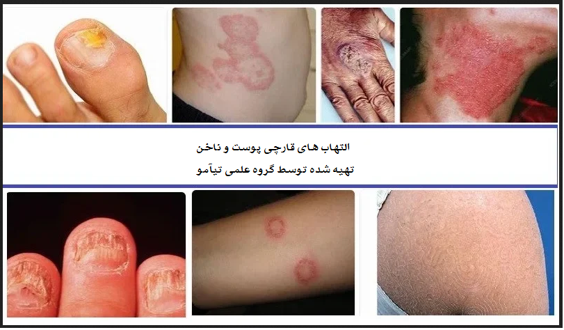 علت و درمان قارچ پوستی و ناخن؛ معرفی بهترین کرم و داروی ضد قارچ