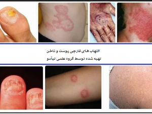 علت و درمان قارچ پوستی و ناخن؛ معرفی بهترین کرم و داروی ضد قارچ