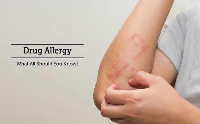 نشانه‌های آلرژی دارویی چیست؟