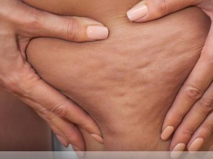 تجمع بافت چربی در ناحیه‌ای از بدن را چاقی موضعی یا به عبارت دیگر سلولیت می‌نامند پدیده سلولیت در زنان رایج تر است و به نظر می‌آید که...