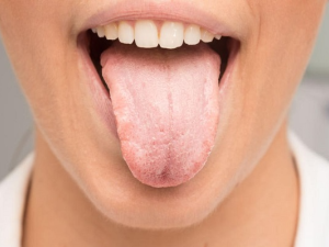کمبود کدام ویتامین باعث خشکی دهان میشود؟