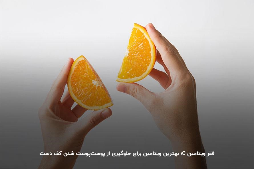 جلوگیری از پوسته شدن کف دست با مصرف پرتقال حاوی مقادیر فراوان ویتامین c