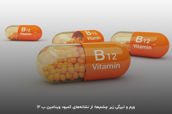 کمبود ویتامین ب 12؛ یکی از اصلی‌ترین دلایل پف زیر چشم