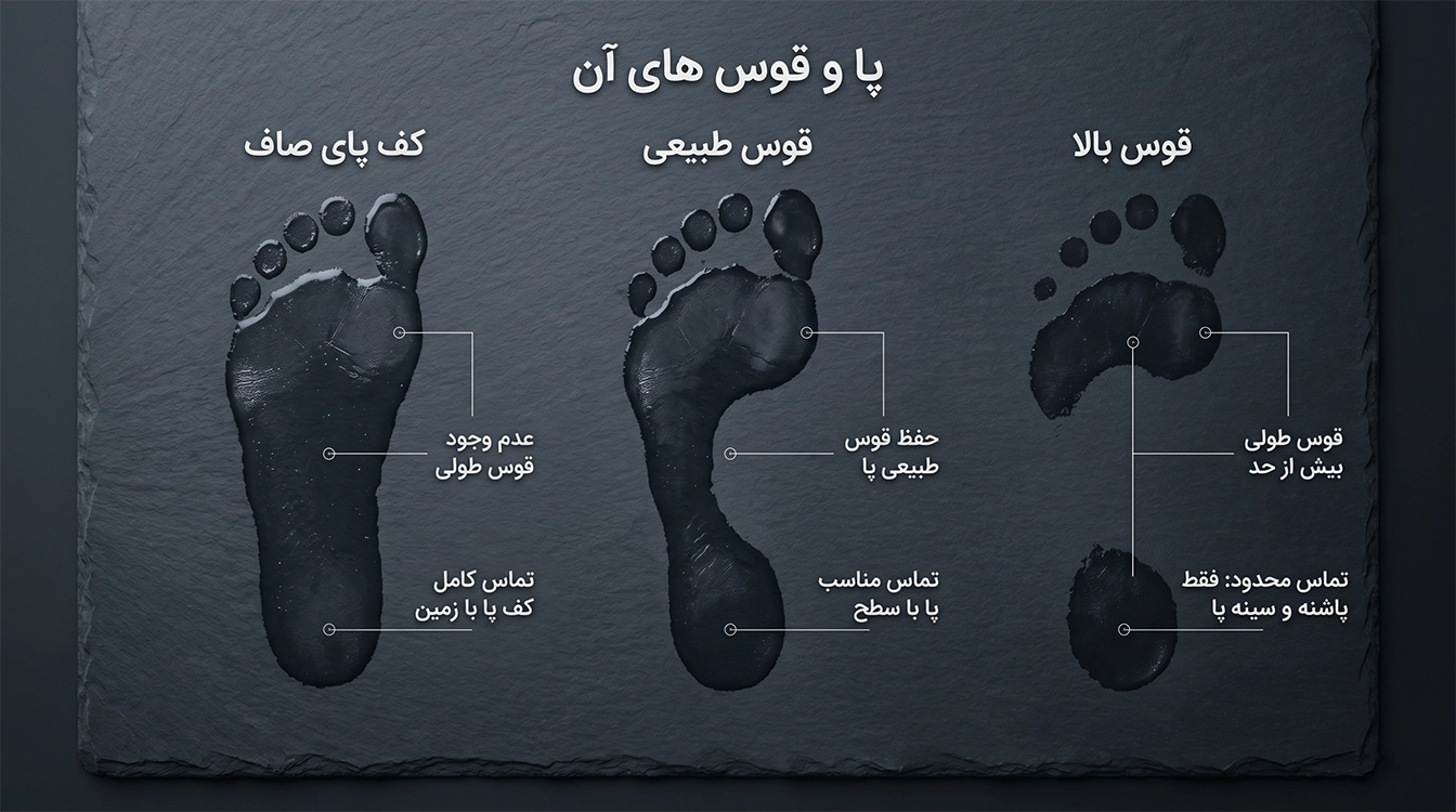 آموزش تست خانگی تشخیص کف پای صاف و نیاز به کفی طبی کفش