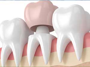 آشنایی با مراحل انجام روکش دندان