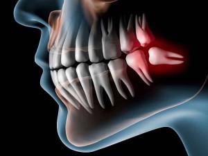 مراقبت های لازم و ضروری بعد از انجام جراحی دندان عقل



به منظور بهبود یافتن هرچه سریع تر دندان عقل بهتر است تا یکسری اقدامات ساده را انجام...