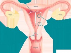 آیودی میرنا  IUD MIRENA