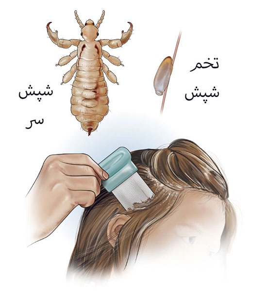 شپش ، علائم، علل و درمان شپش سر